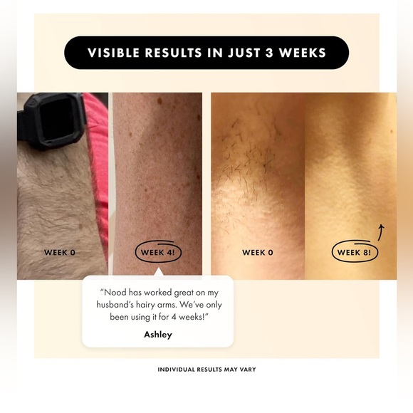 Flasher 2.0 by Nood, IPL Laser Hair Removal Device Pain-free and Permanent Black - Picture 4 of 9